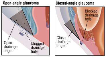 angle closure glaucoma vs open angle